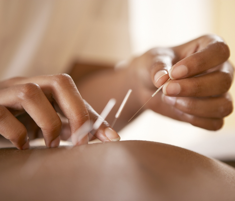 Person receiving acupuncture treatment